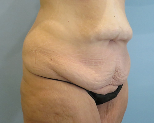 Tummy Tuck | 360 Body Lift Before & After case 25