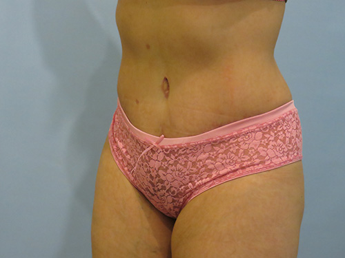 Tummy Tuck | 360 Body Lift Before & After case 6