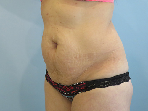 Tummy Tuck | 360 Body Lift Before & After case 6