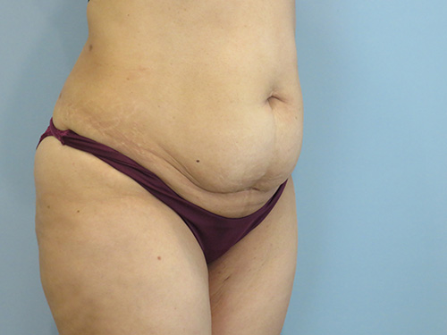 Tummy Tuck | 360 Body Lift Before & After case 8