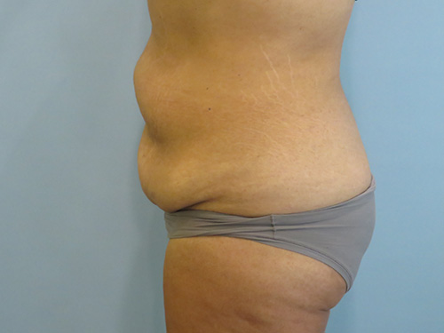 Tummy Tuck | 360 Body Lift Before and After case 1