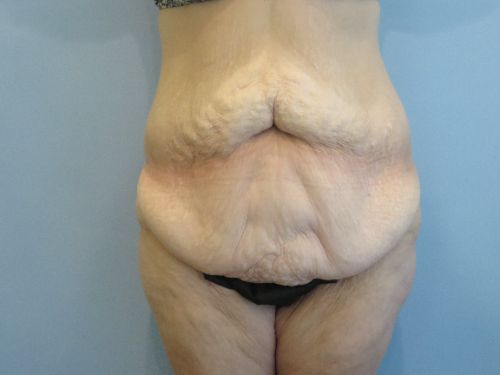 Tummy Tuck | 360 Body Lift Before and After case 3