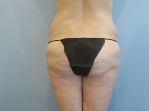 Tummy Tuck | 360 Body Lift Before and After case 3