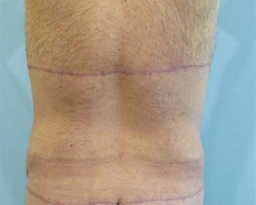 Tummy Tuck | 360 Body Lift Before and After case 4