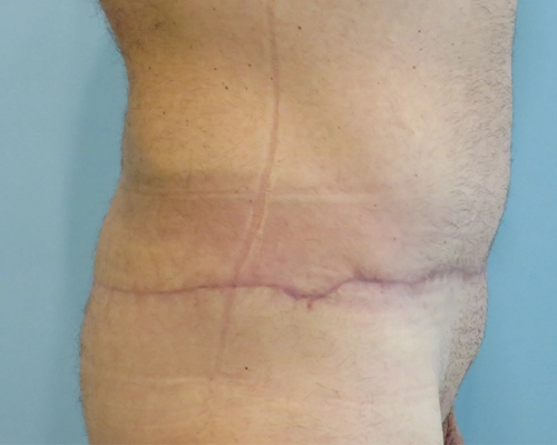 Tummy Tuck | 360 Body Lift Before and After case 4