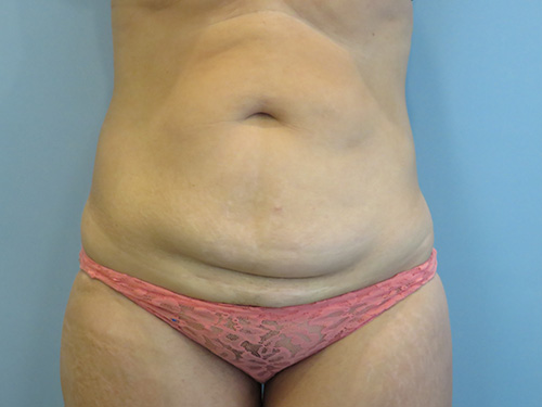 Tummy Tuck | 360 Body Lift Before and After case 9