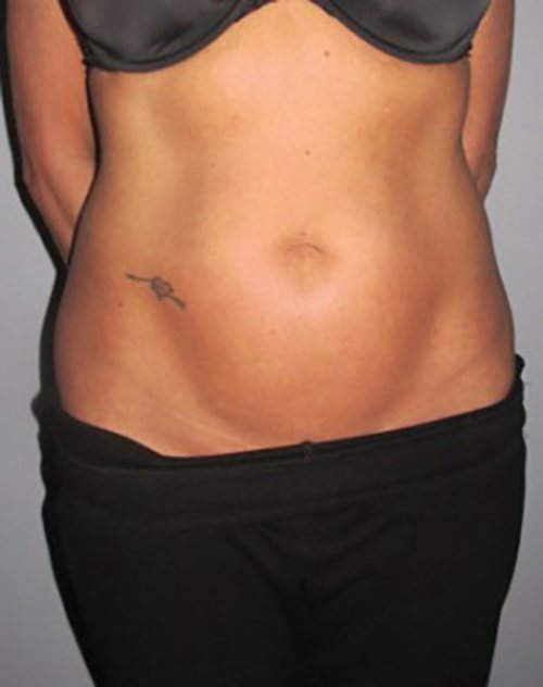 Venus Freeze Before & After case 10