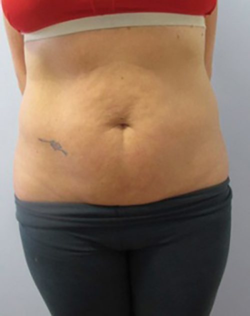 Venus Freeze Before & After case 10