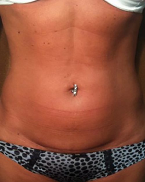 Venus Freeze Before & After case 11