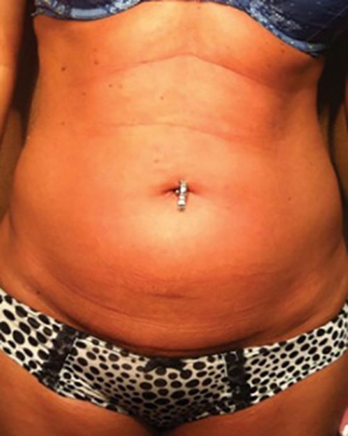 Venus Freeze Before & After case 11