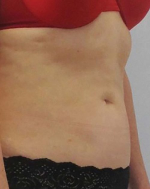 Venus Freeze Before & After case 12