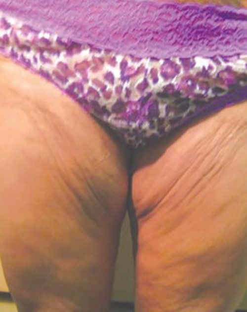 Venus Freeze Before & After case 13