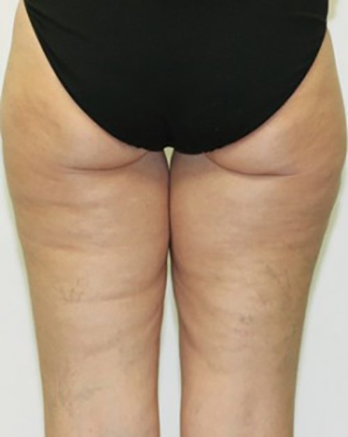 Venus Freeze Before & After case 14