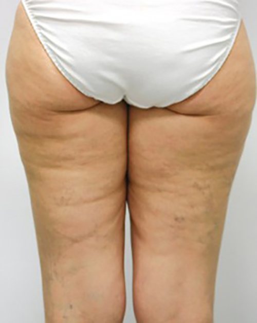 Venus Freeze Before & After case 14