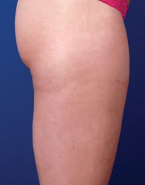 Venus Freeze Before & After case 15