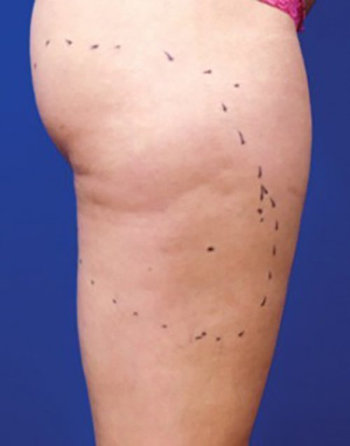 Venus Freeze Before & After case 15