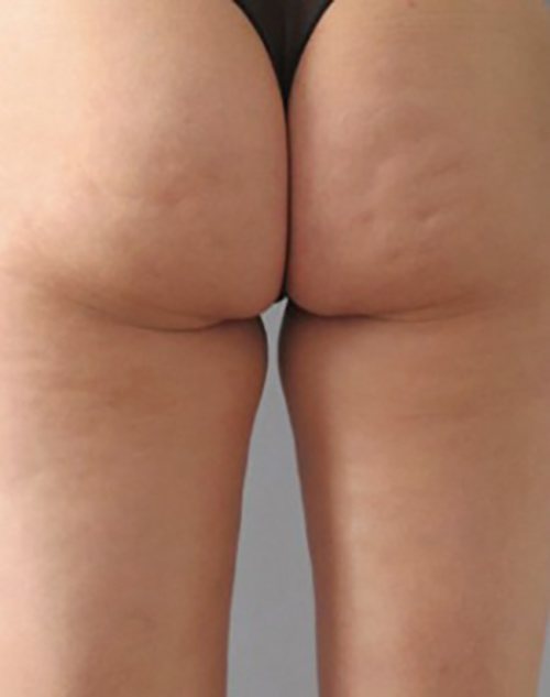 Venus Freeze Before & After