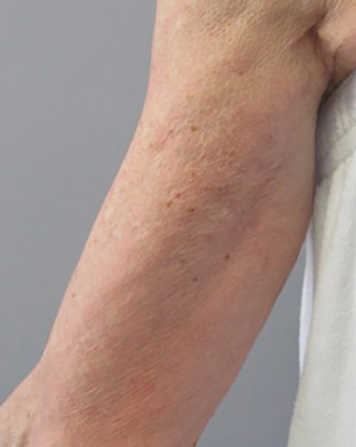 Venus Freeze Before & After case 17