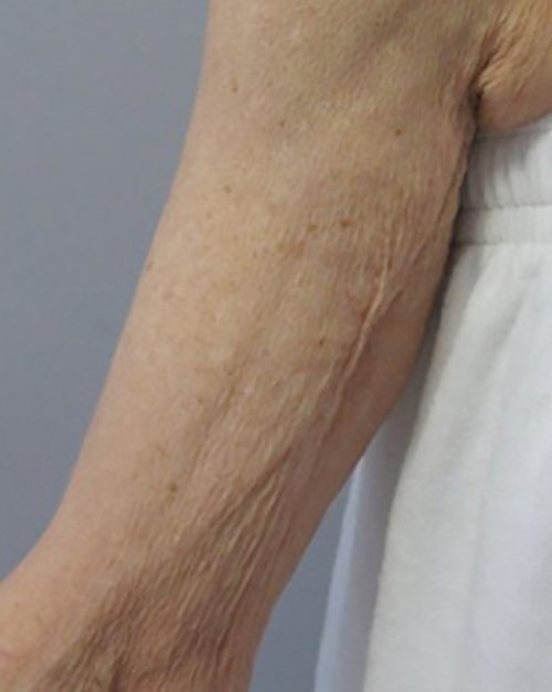 Venus Freeze Before & After case 17