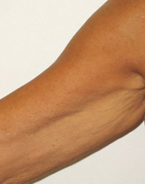 Venus Freeze Before & After case 18