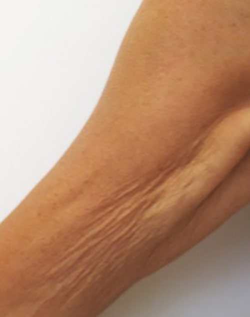 Venus Freeze Before & After case 18