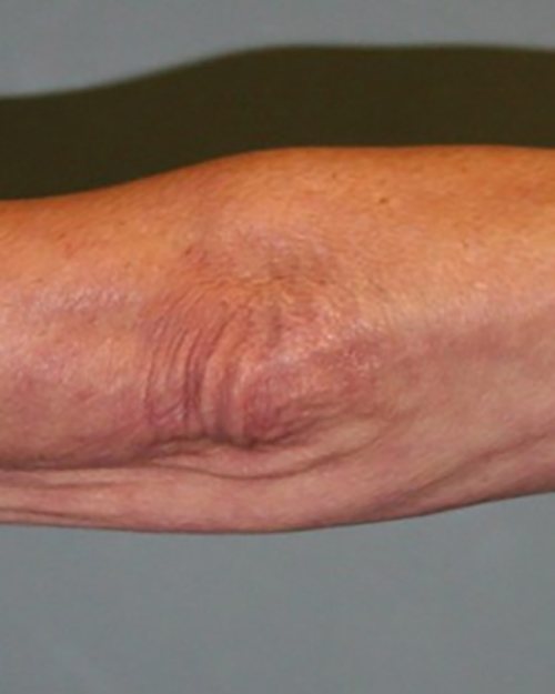 Venus Freeze Before & After case 19