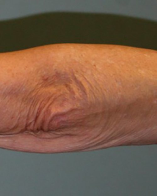 Venus Freeze Before & After case 19