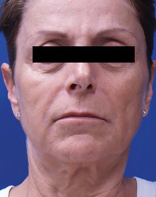 Venus Freeze Before & After Case 1