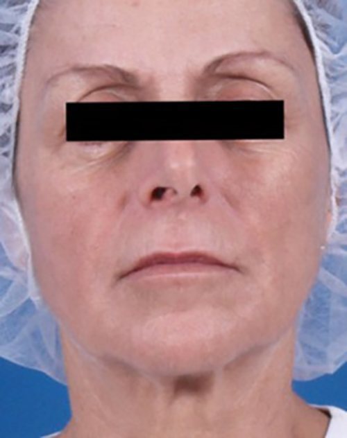 Venus Freeze Before & After Case 1