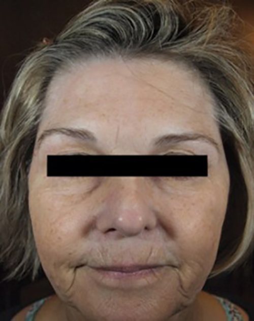 Venus Freeze Before & After Case 3