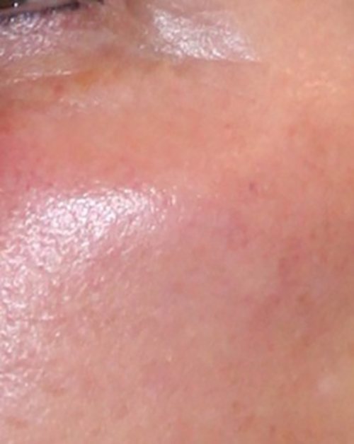 Venus Freeze Before & After case 4