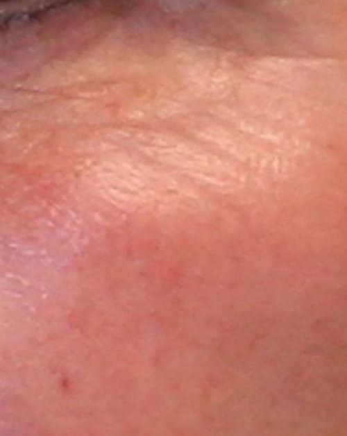 Venus Freeze Before & After case 4