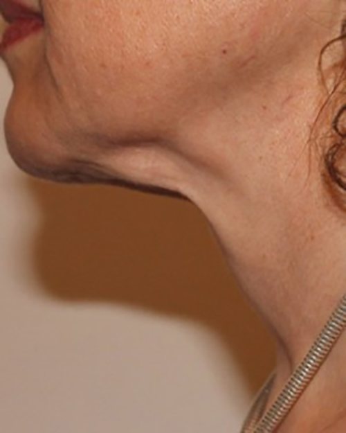 Venus Freeze Before & After Case 5