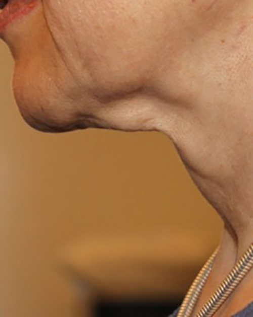 Venus Freeze Before & After Case 5