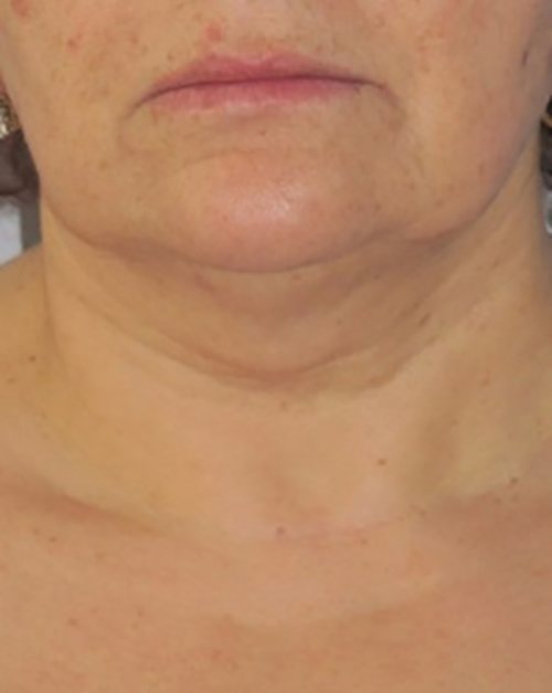 Venus Freeze Before & After case 6