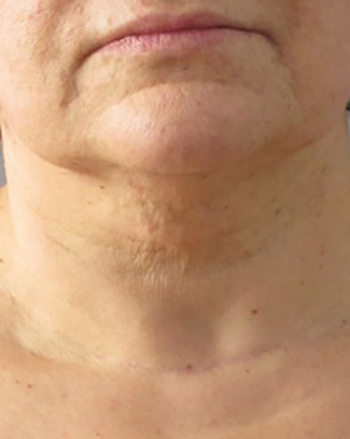 Venus Freeze Before & After case 6