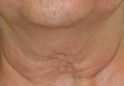 Venus Freeze Before & After case 7