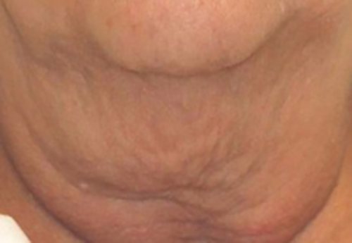 Venus Freeze Before & After case 7