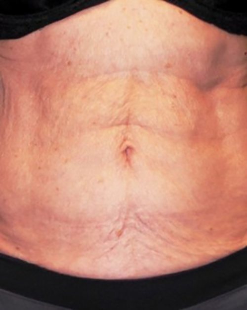 Venus Freeze Before & After Case 8