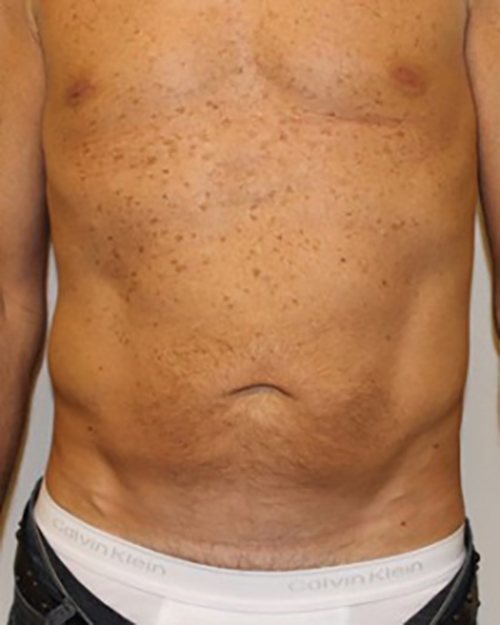 Venus Freeze Before & After case 9