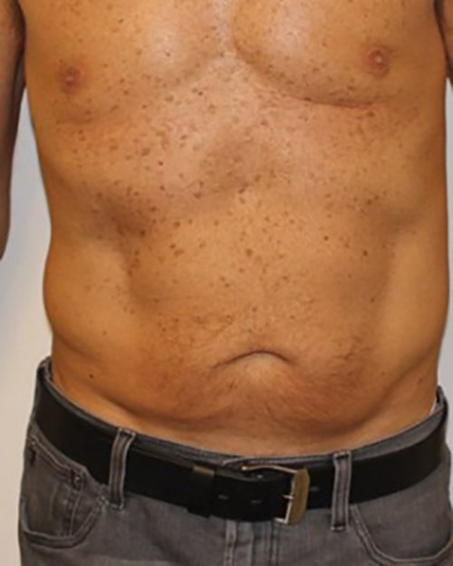 Venus Freeze Before & After case 9