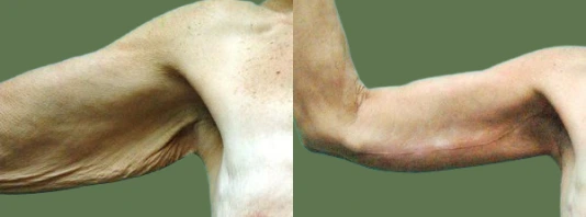 What Is an Arm Lift? Banner