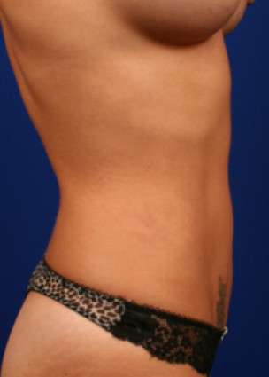 Case 2.1 vaser lipo after