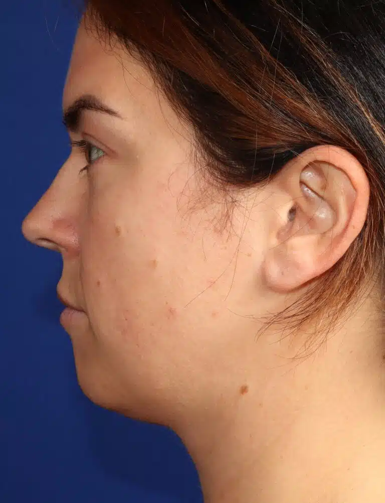 Deep Neck Lift & Chin Implant 1.2 before