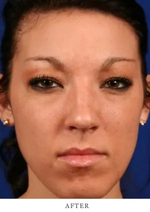 Facelift & Neck Lift Before & After Case 2.2 Results images