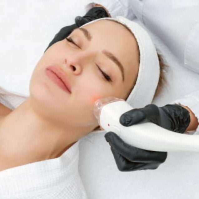 Laser Facial Peel in Springfield Banner