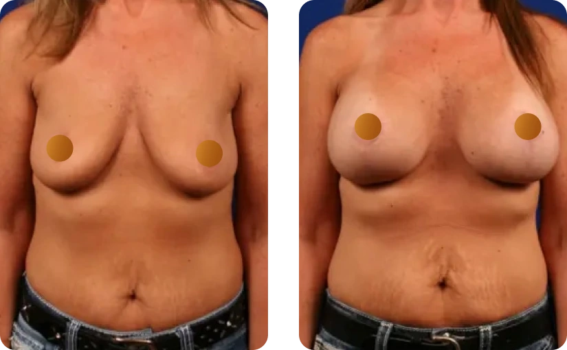 Breast Lift Before and After Banner
