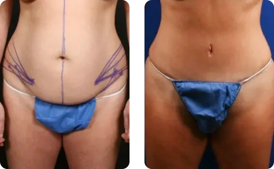 Mini Tummy Tuck Before & After