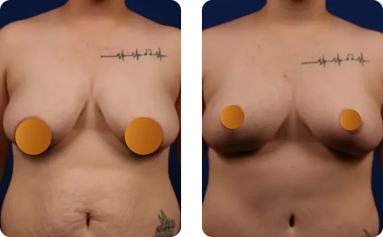 View our Breast Reduction Results Banner
