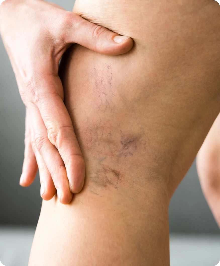 About Varicose Veins banner
